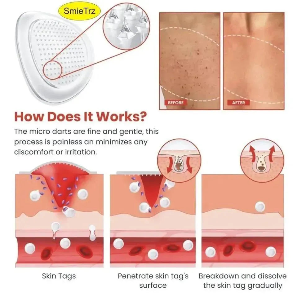 Skin Tag Remover
