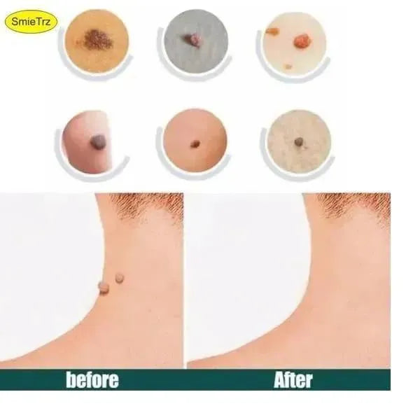 Skin Tag Remover